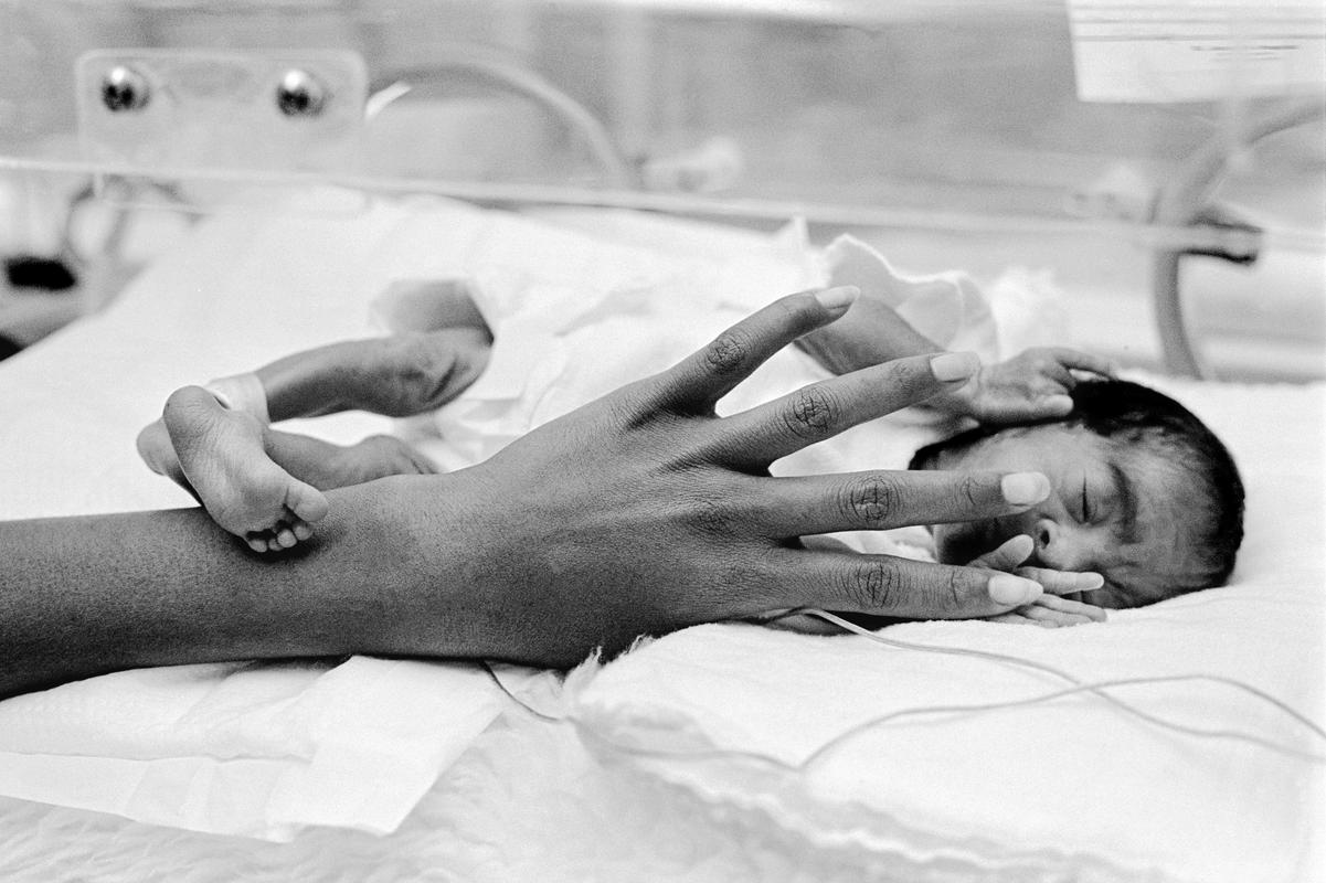 Preemie Baby unit at St Joseph&#039;s Hospital. She has a head too large by half for her body. Phoenix, Arizona USA